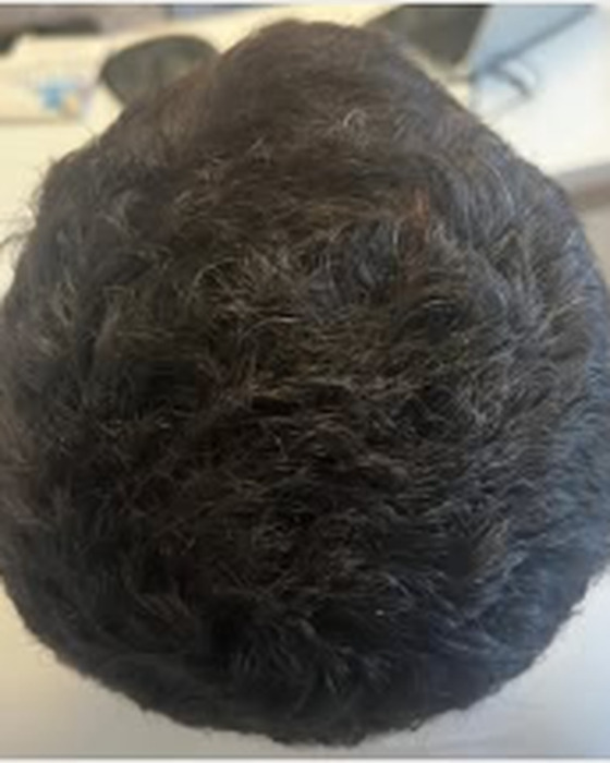 Comparação antes e depois de acompanhamento capilar