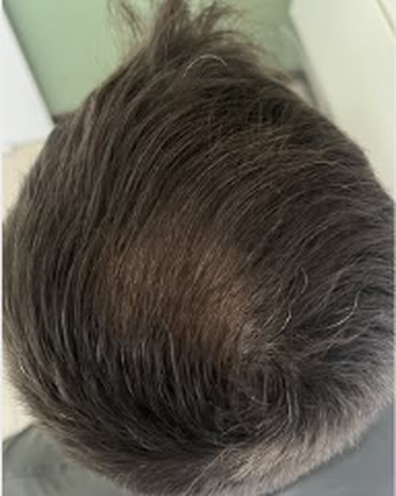 Comparação antes e depois de acompanhamento capilar