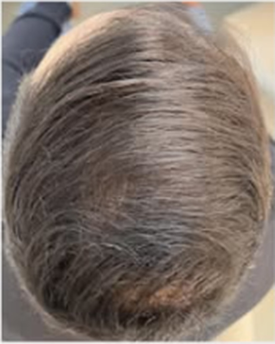 Comparação antes e depois de acompanhamento capilar